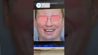 Цифровой аватар пациента в действии. Имплантация зубов. #dentist