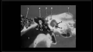 Temporal Bone Pathologies DDX : part 1