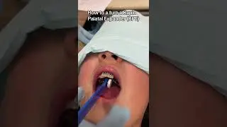 How to turn a Rapid Palatal Expander (RPE)