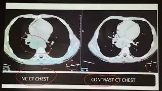 Imagining of lungs 🫁 #lung #imaging #USG #CTscan 