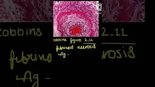 #robbins #pathology #figure #2.11 #flashcards #aiims #medical #easy
