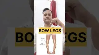 BOW LEGS RELIEF EXERCISE#physiotherapy#exercise#ytshorts#viralvideo#treanding#shortsfeed#shortsvideo