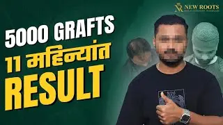 Grade 5 Baldness Defeated 😎 | Hair Transplant in Mumbai | Cost & Best Results | New Roots