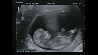 2D Pretecho 11 Weken Zwanger Filmpje