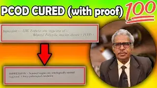 PCOD cured by Homeopathy medicine (with proof) - Dr P.S. Tiwari