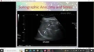 جلسه نوزدهم :Splenomegaly-Splenic Cyst - Splenic mass
