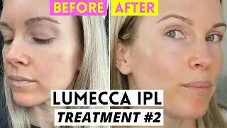 LUMECCA IPL BEFORE & AFTER | TREATMENT 2