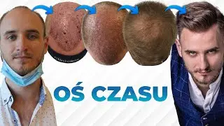 Rekonwalescencja Po Przeszczepie Włosów | Oś czasu