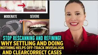 OOPSIES Your Invisalign Clear Aligner Case is WAY OFF TRACK- How to Fix this w/o a LONG Refinement