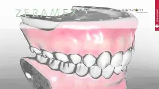 ZERAMEX&reg;T Keramikimplantate f&uuml;r Patienten