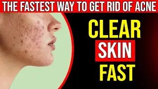 The FASTEST Way to Rid Acne &ndash; Dermatologist&rsquo;s Secret Finally Exposed!