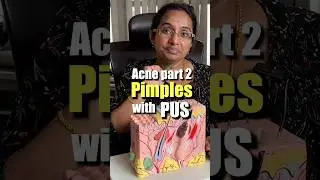 How To Treat Pus Filled Acne At Home | Papules & Pustules #trending