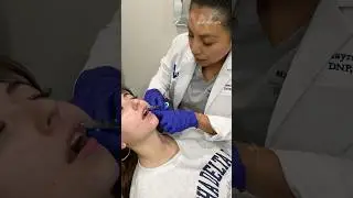 Before and after results: Lip Filler with Restylane Kysse and Chin Filler for profile definition