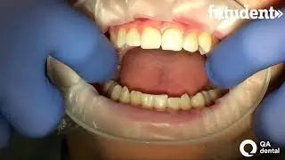 OptraGate insertion