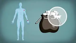 Celblaasjes als therapie voor reuma?
