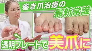 巻き爪治療の最新常識！透明プレートで美爪に✨