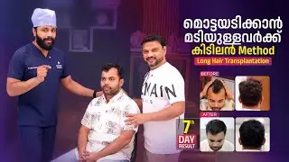 മൊട്ടയടിക്കാൻ മടിയുള്ളവർക്ക് കിടിലൻ Method Long Hair Transplantation!