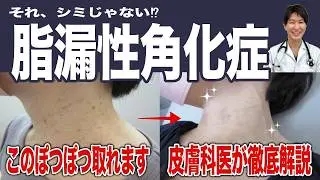 脂漏性角化症とはどんな病気？実は誰にでも起こる症状です！放っておいても大丈夫？自然に取れる？どんな治療があるの？よくある疑問を皮膚科専門医医が徹底解説！