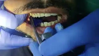 occlusion checking / Articulating paper use / blue paper / lateral movement