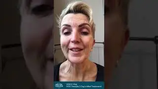 Vicki's Vlog - PDO Threads - 3rd Day After Treatment
