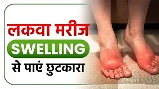 लकवा मरीज सूजन कैसे ठीक करें | Paralysis Patient Swelling Recovery | Dr Puru Dhawan