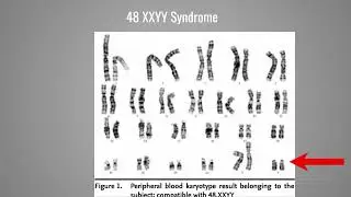 48 XXYY Syndrome