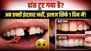 टूटा हुआ दांत? अब इंतज़ार नहीं! Same Day 1 Day Crown Treatment | Dr Renu Dental Jaipur