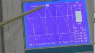 Meridian Digital Pulsewave Analyzer- 1 Minute PTG & Printout