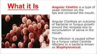 How to Get Rid of Angular Cheilitis Fast & Easy - Fast Method To  Get Rid of Angular Cheilitis