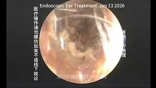 Routine earwax removal, daily procedure 20260113