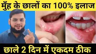 Muh ke Chale Kaise Theek Kare | Mouth Ulcer Home Remedy | Mouth Ulcer Treatment 