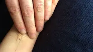 Acupressure for Nei Guan - Pericardium 6 (N&egrave;i Guān 内关Pc 6)