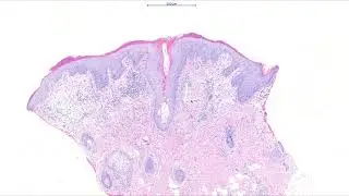 Dermpath educational case 16.6.25 - biopsy from a rash on the face