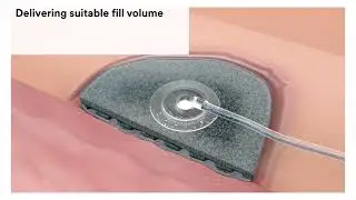 How to use: 3M&trade; V.A.C.&reg; Ulta 4 Therapy System