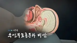 [Medical Encyclopedia📖] Sleep Apnea and Obesity