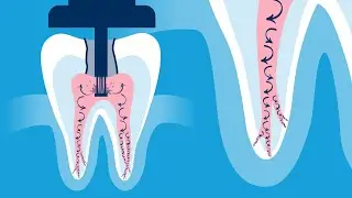 Discover the Innovative GentleWave&reg; Procedure
