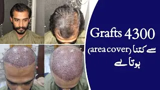 How much area covered by 4300 grafts || Dr. Habib Ullah Shah
