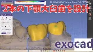 #282　exocad設計　2本の下顎大臼歯を設計（解説なし版）