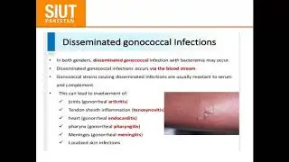 Online Urology Journal Club at SIUT on 22nd May 2020: Gonococcal Infections,