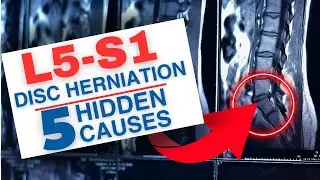 5 Non-Traumatic Causes of L5-S1 Disc Herniation | Dr. Marc Dupuis Chiropractor in Sanford ME
