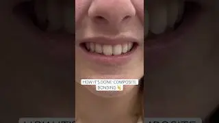 Watch Dr. Josh work as he perfects this smile using composite bonding. #ruhdental #compositebonding