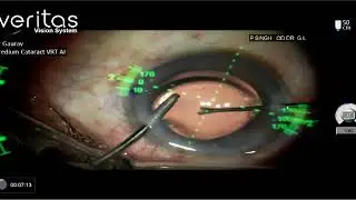 Live Cataract Surgery by Dr Gaurav Luthra