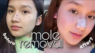 MOLE REMOVAL | did i regret it?