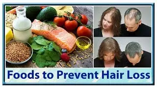 Top 5. Foods to Prevent Hair Loss