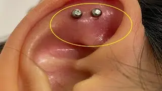 how to get rid of ear piercing swelling fast