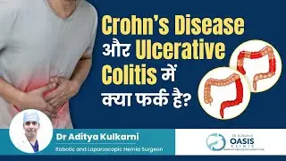 Crohn&rsquo;s Disease और Ulcerative Colitis में क्या फर्क है? | IBD Treatment Explained Dr Aditya Kulkarni