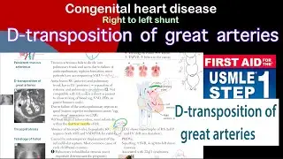 Transposition of great arteries in Hindi/Urdu by first aid for USMLE step 1