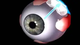 Ahmed Glaucoma Valve: Leading glaucoma drainage device (New World Medical)