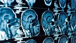The Link Between Dental Health and Alzheimer&rsquo;s