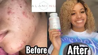 ALANI NU BALANCE FOR ACNE | HONEST REVIEW | Acne, PCOS, Hormonal Balance